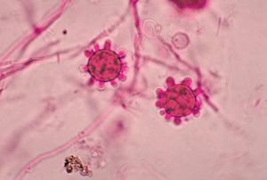 #164: Histoplasmosis